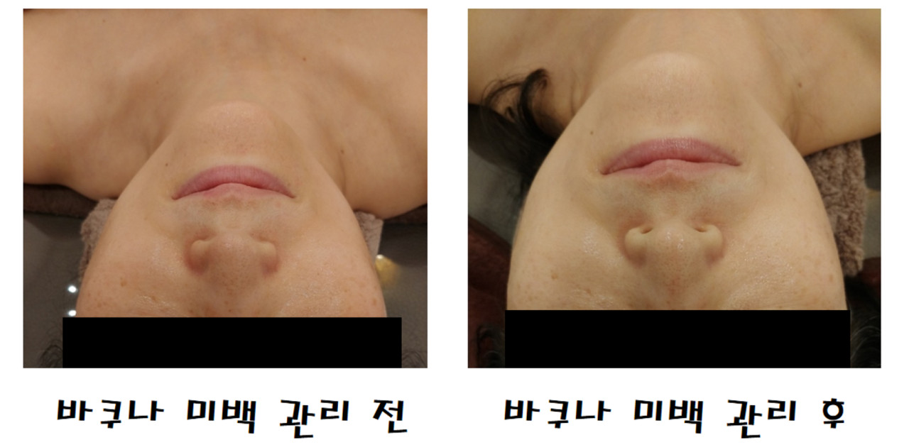 로뎀피부