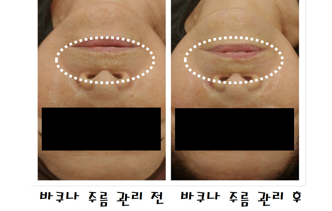 로뎀피부