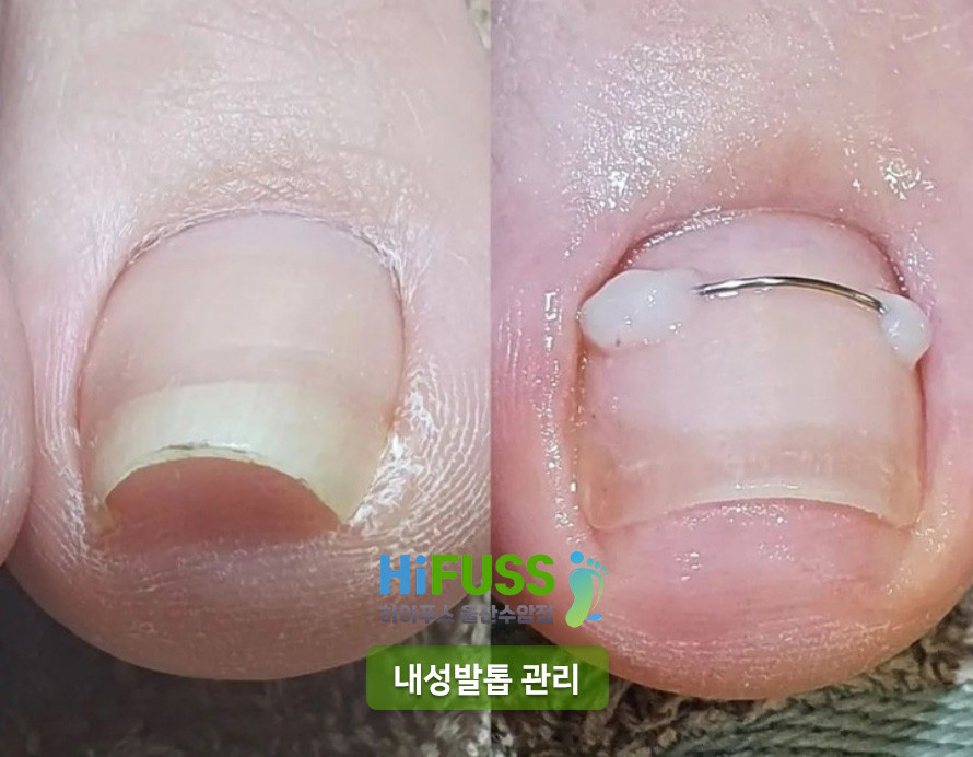 하이푸스울산수암점
