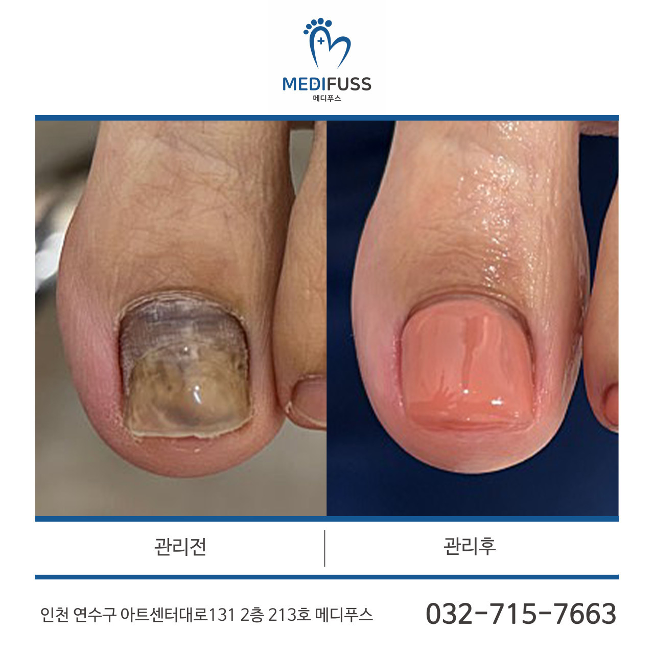 메디푸스