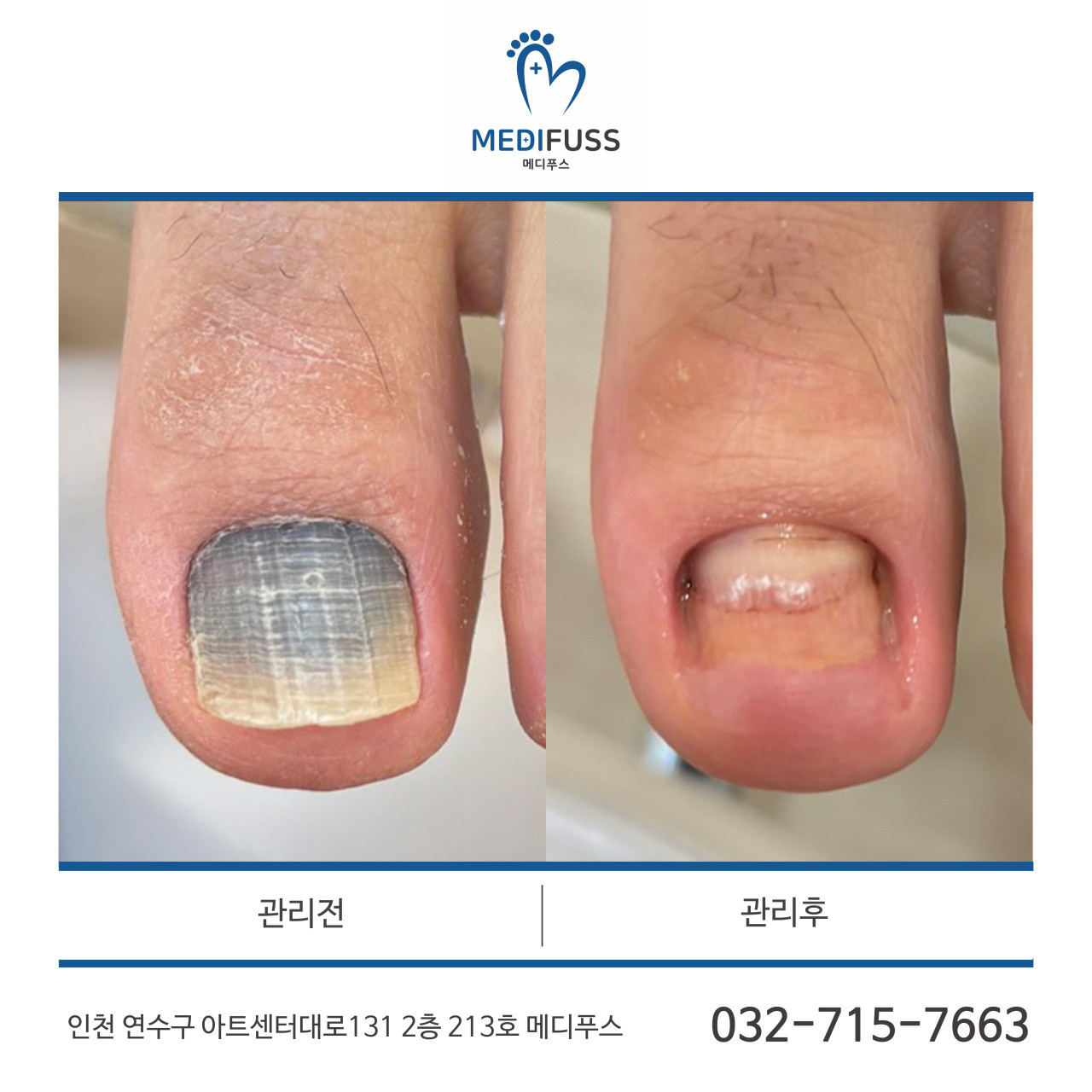 메디푸스