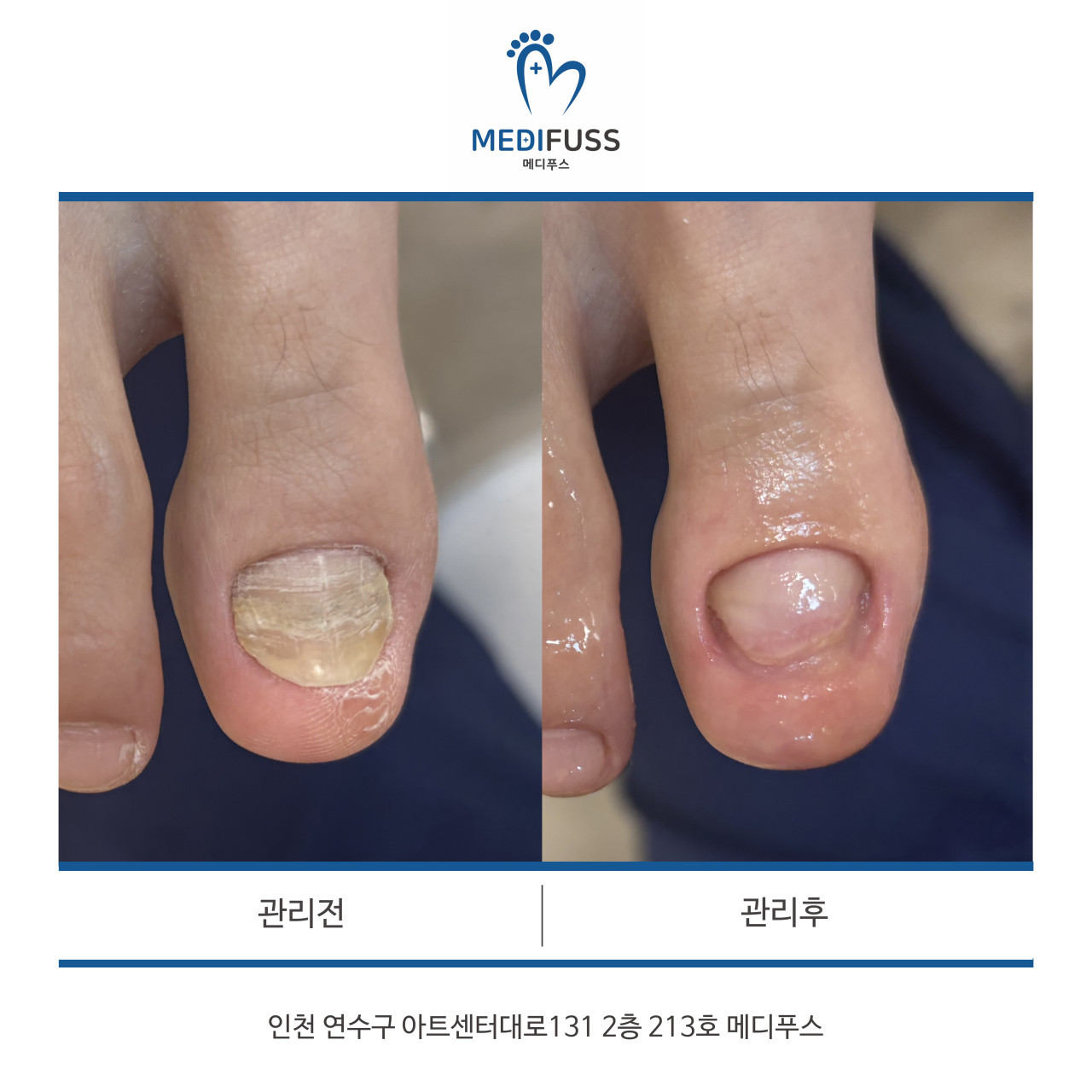 메디푸스