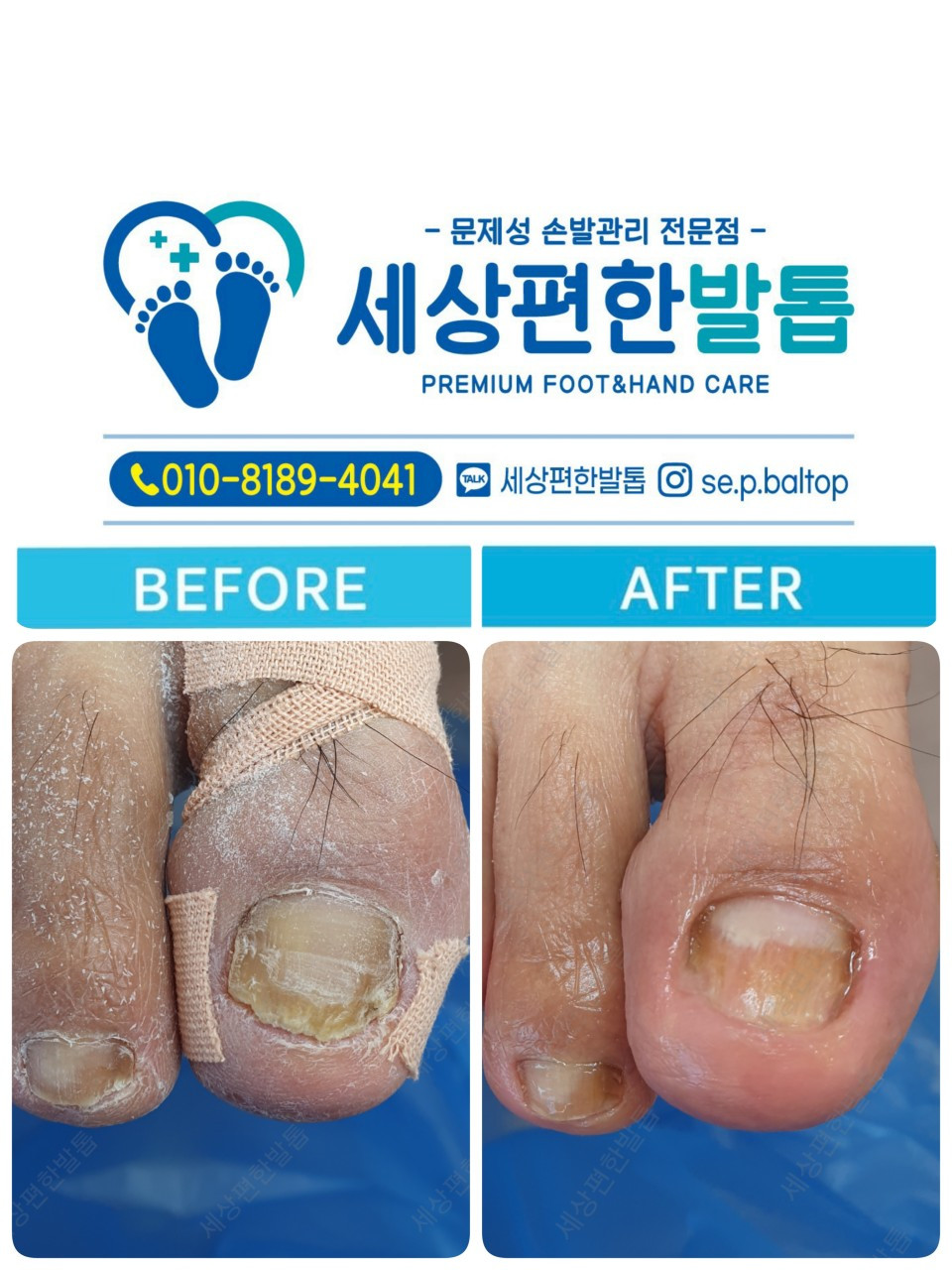 세상편한발톱