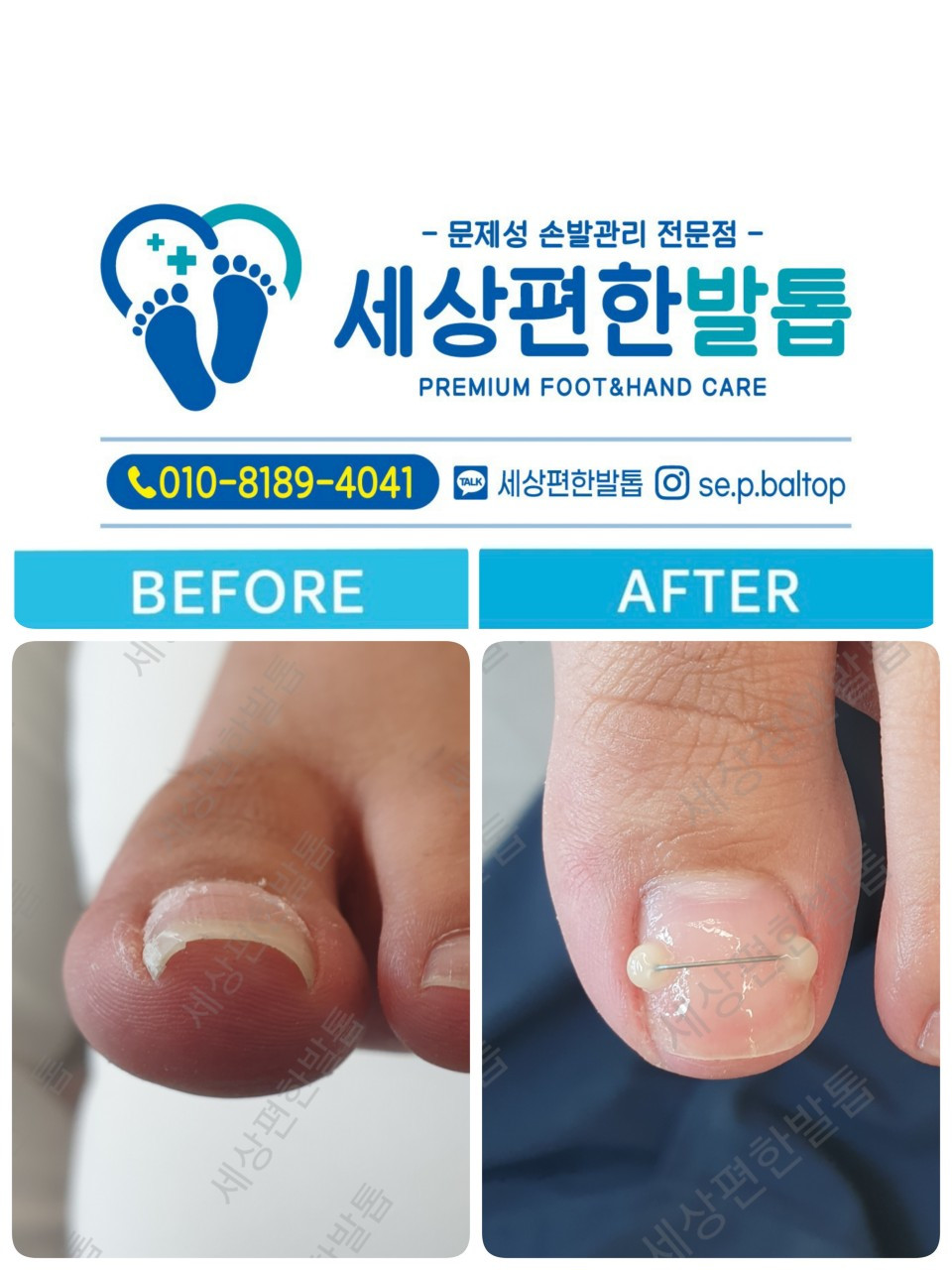 세상편한발톱