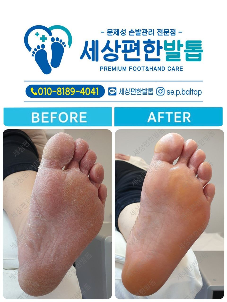 세상편한발톱