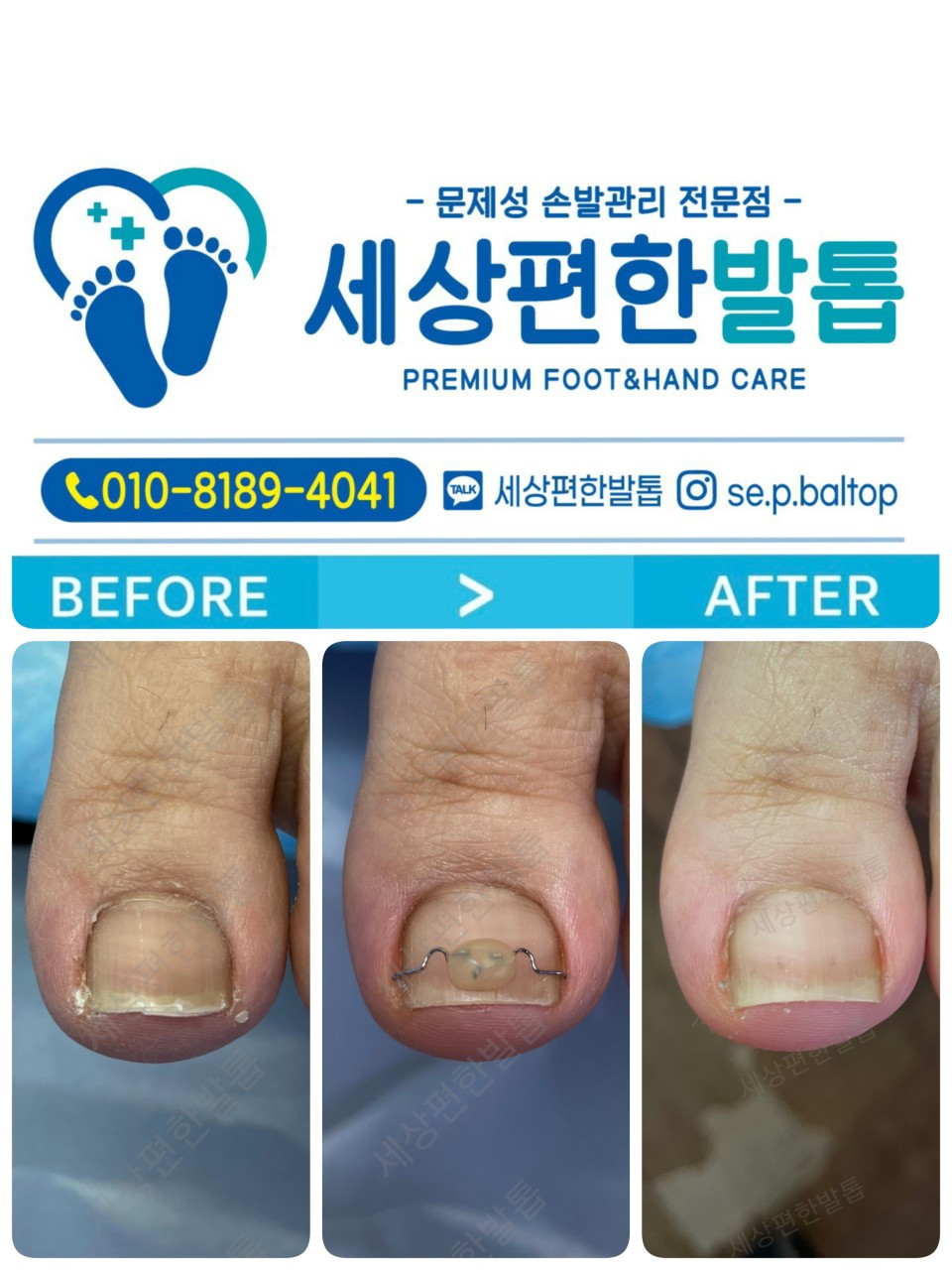 세상편한발톱
