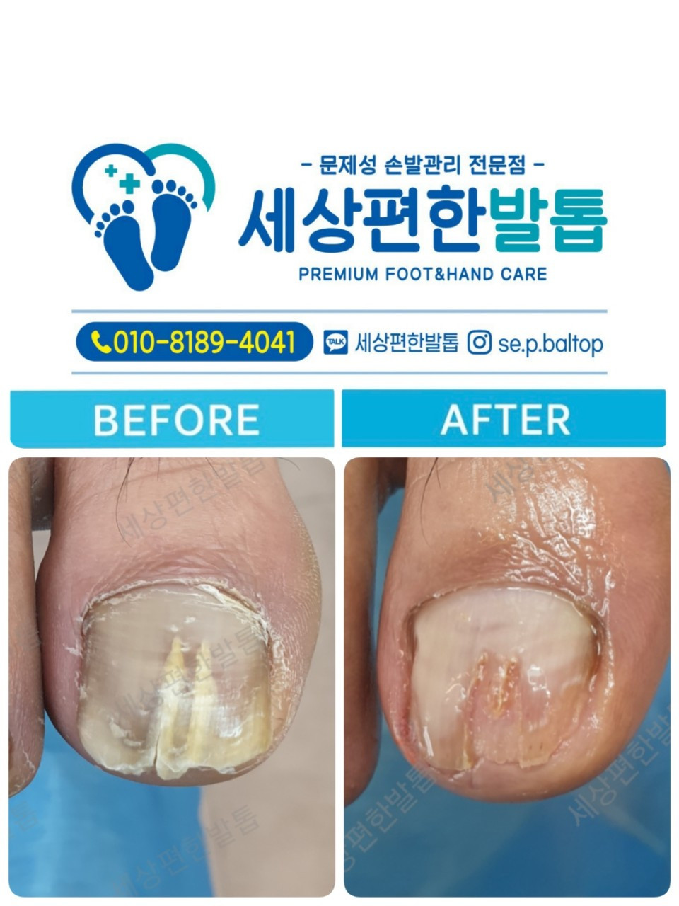 세상편한발톱