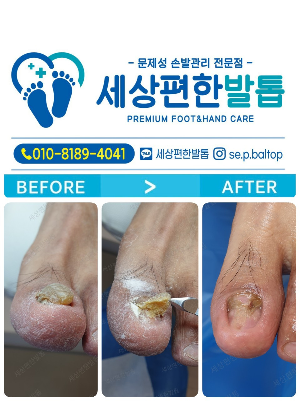 세상편한발톱