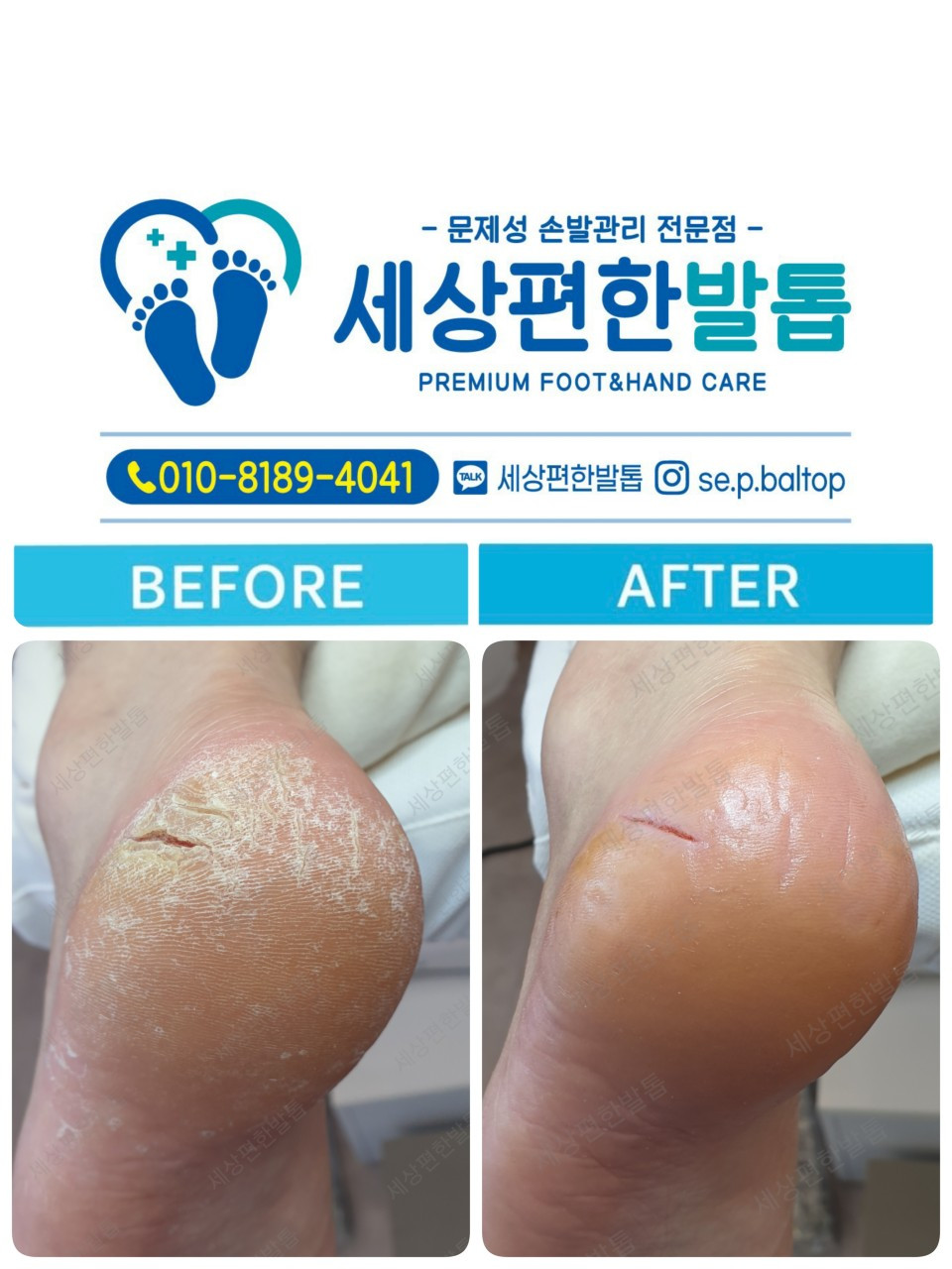 세상편한발톱
