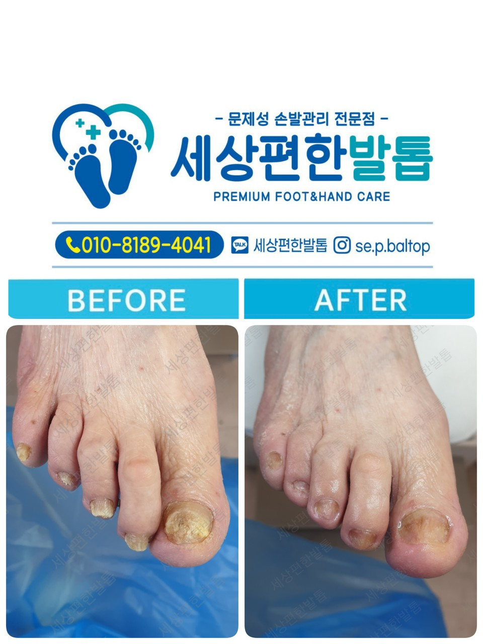 세상편한발톱
