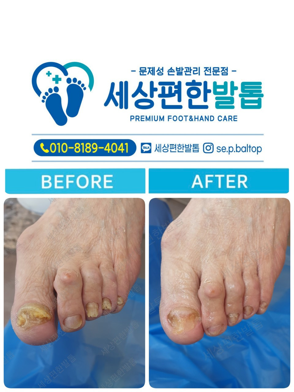 세상편한발톱