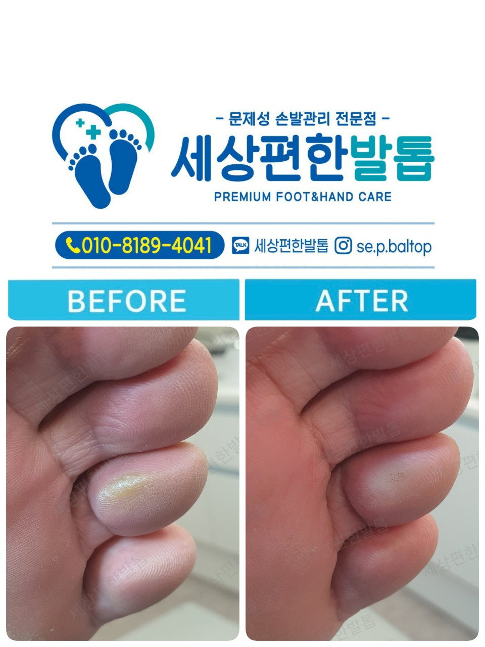 세상편한발톱