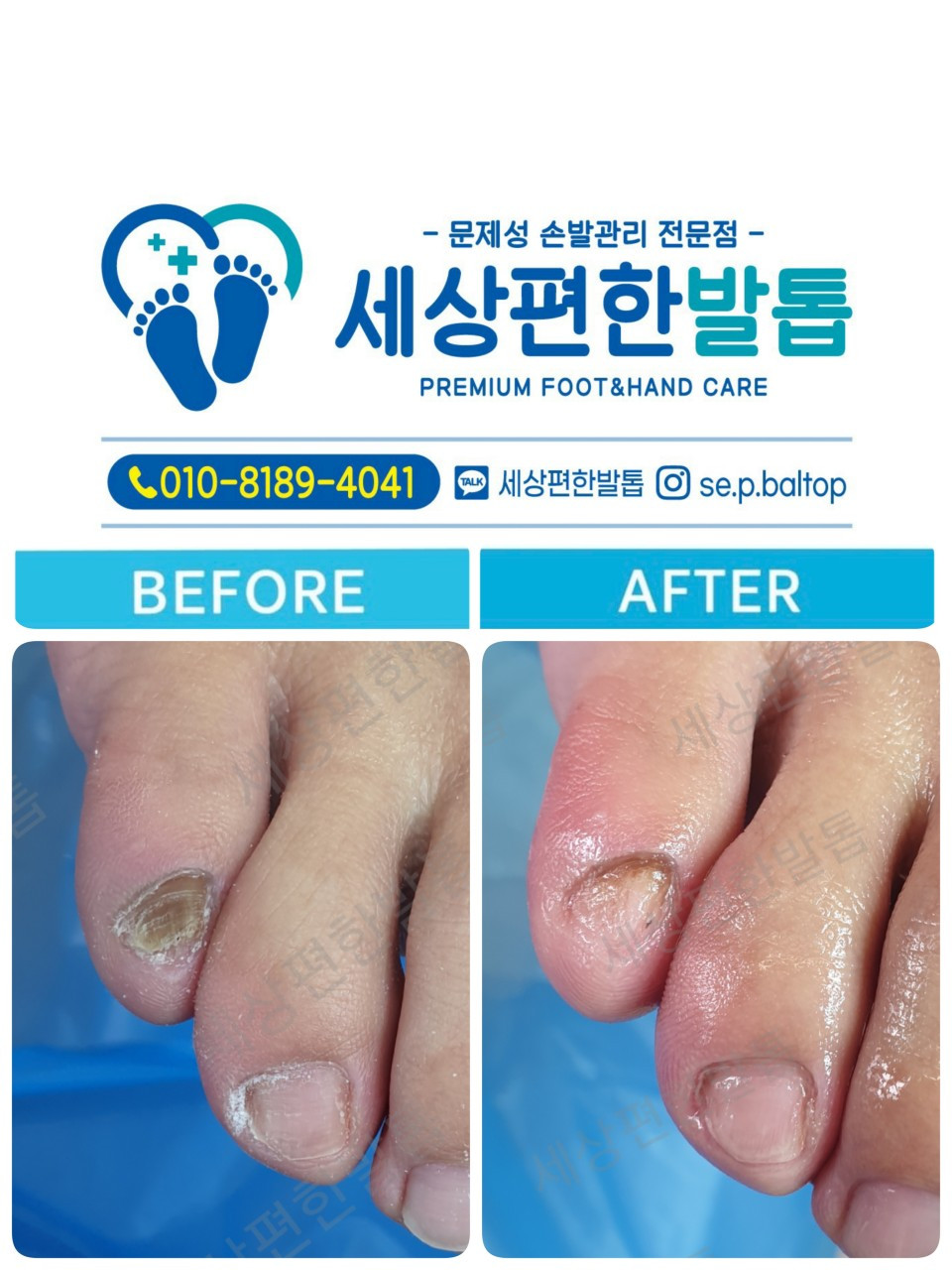 세상편한발톱