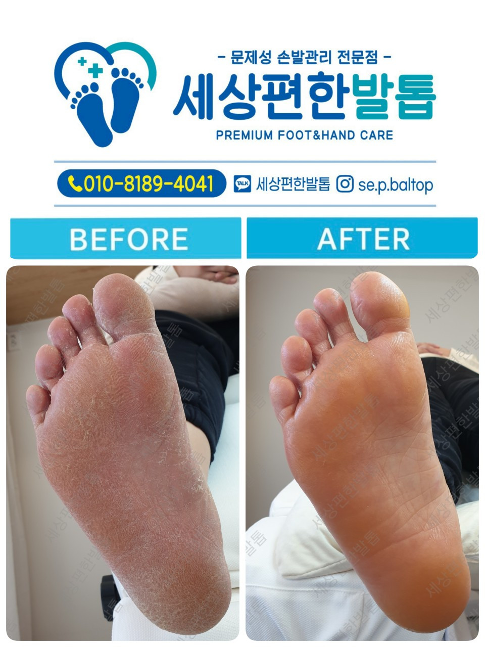 세상편한발톱