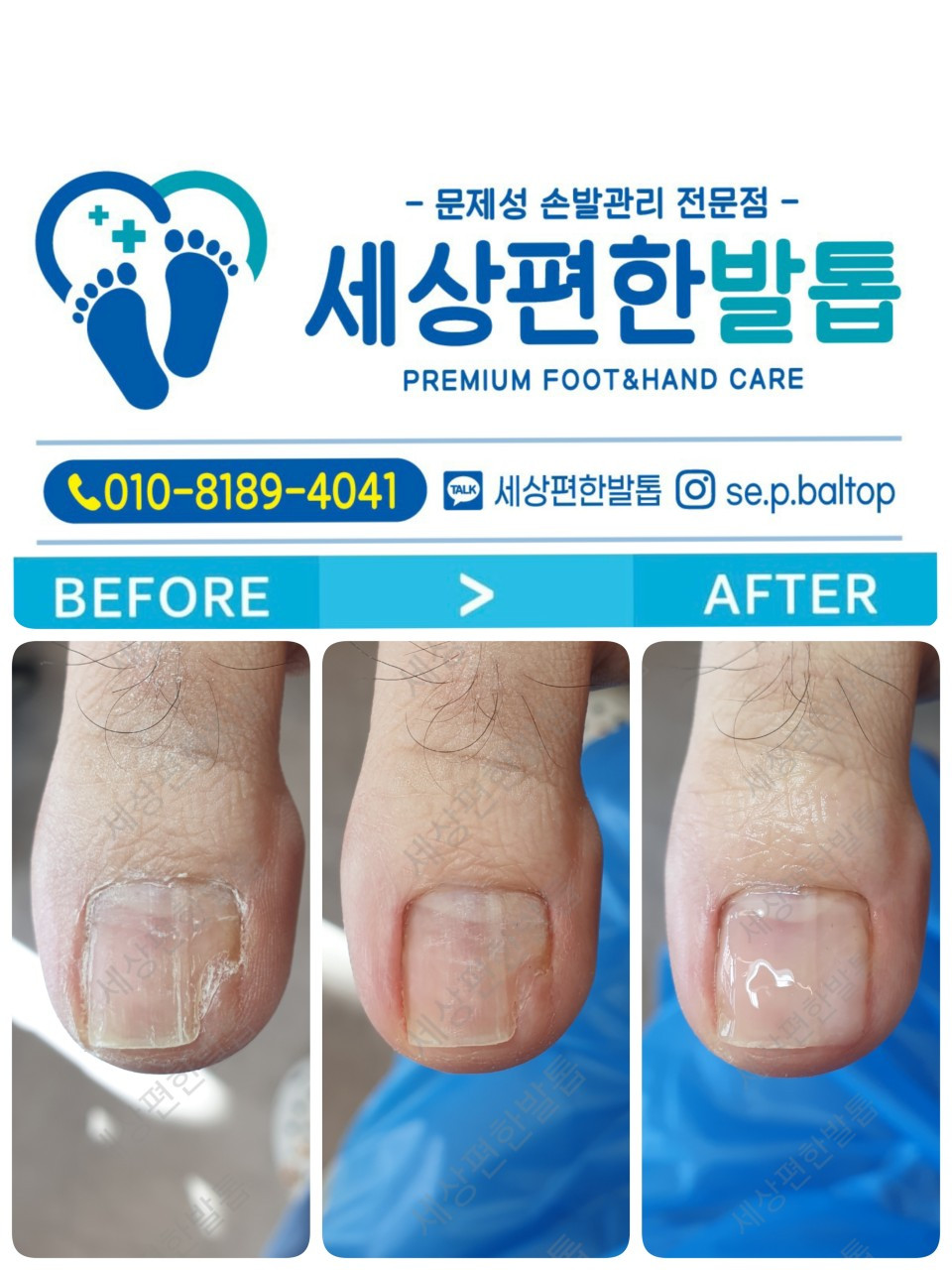 세상편한발톱