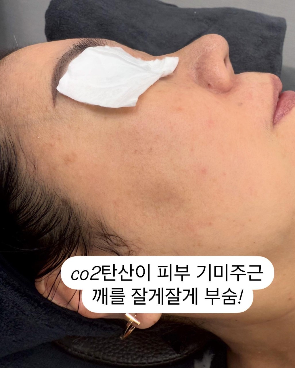 스킨블리스