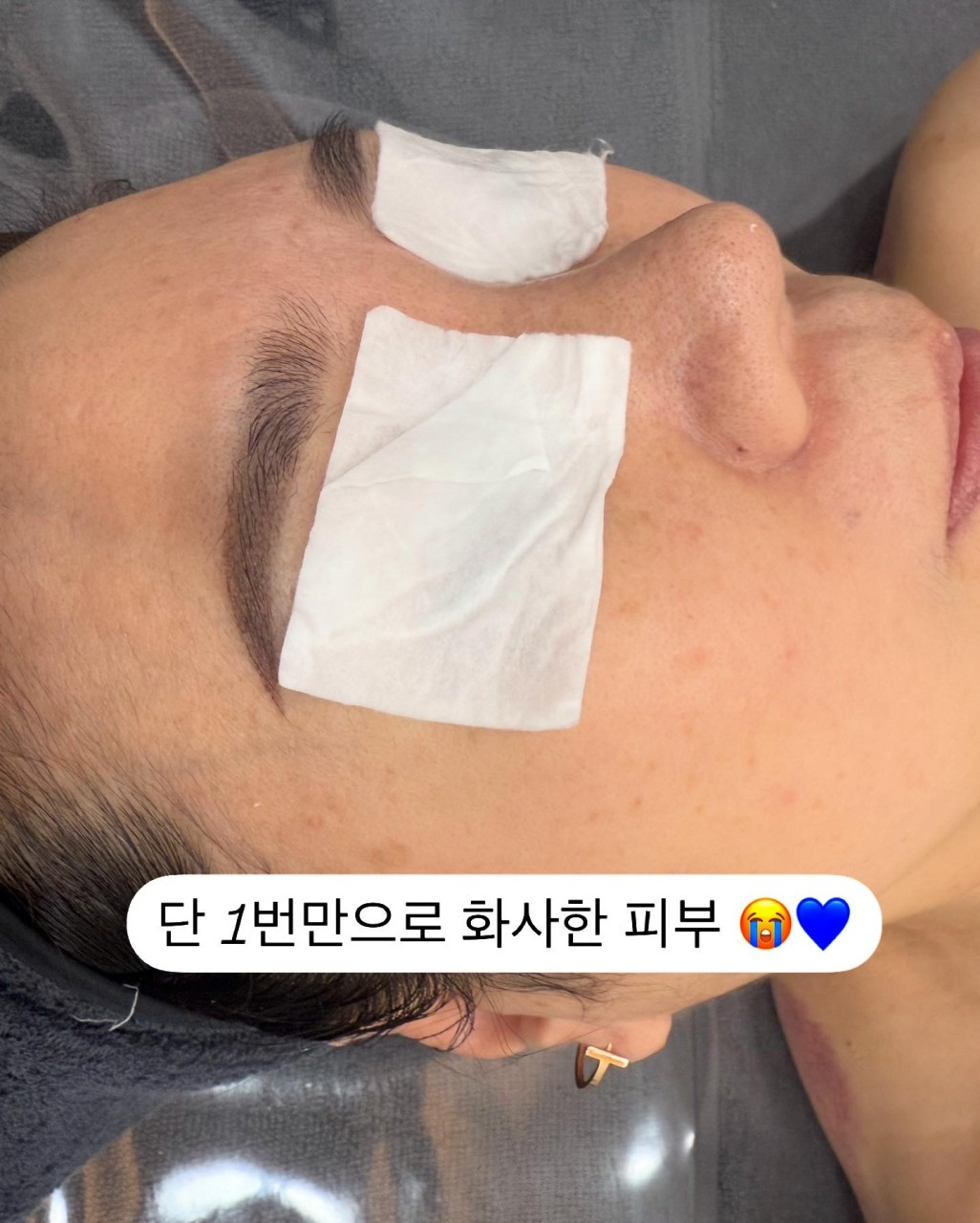 스킨블리스